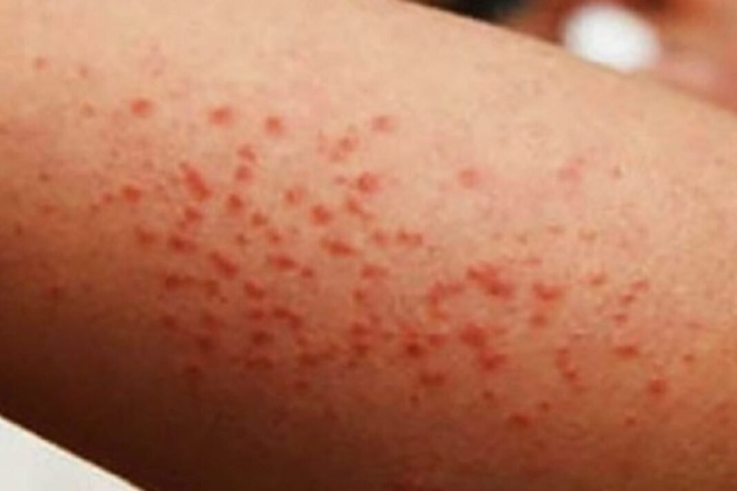 sarampion-sinaloa-ssa